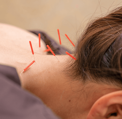 首の後ろに鍼をしている女性