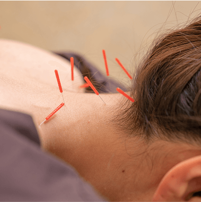 鍼灸施術の様子